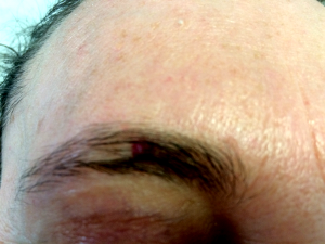 Image angiome du sourcil