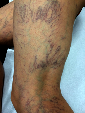Image télangiectasie varicosités
