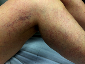 Image télangiectasie varicosités