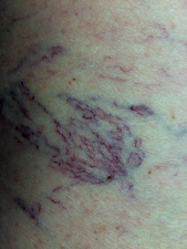 Image télangiectasie varicosités