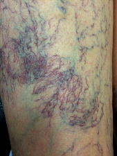 Image télangiectasie varicosités