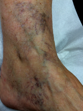 Image télangiectasie varicosités