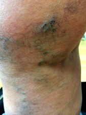 Image télangiectasie varicosités