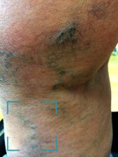 Image veine réticulaire