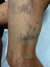 Image veine réticulaire